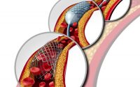 angioplasty and stent concept as a heart disease treatment symbol diagram with the stages of an implant procedure in an artery that has cholesterol plaque blockage being opened for increased blood flow as a 3d illustration.